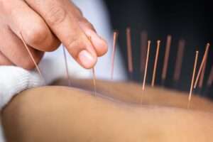 saskatoon acupuncture dry needling axis health center physiotherapy massage chiropractor