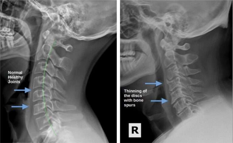 degenerative disc disease axis health center saskatoon chiropractor physiotherapy massage acupuncture