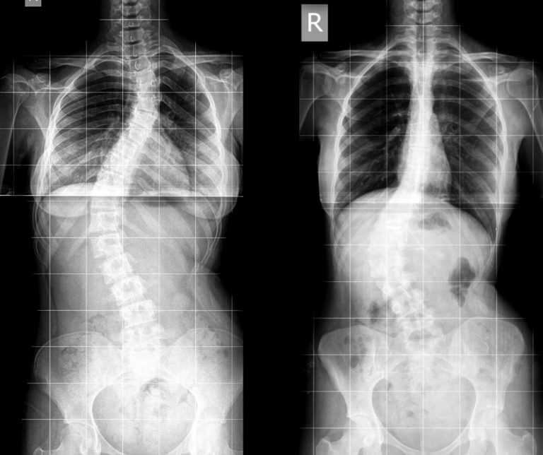 scoliosis chiropractic treatment axis health center saskatoon